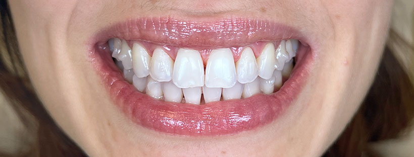Humaniza Odontologia - Invisalign: os benefícios do tratamento