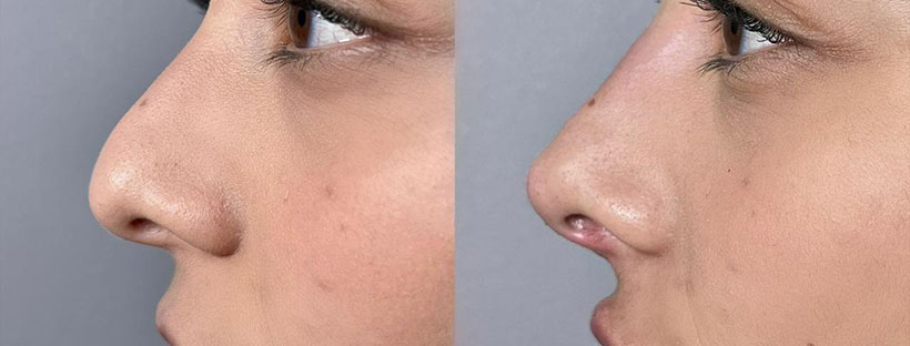 antes e depois de preenchimentos faciais com ácido hialurônico